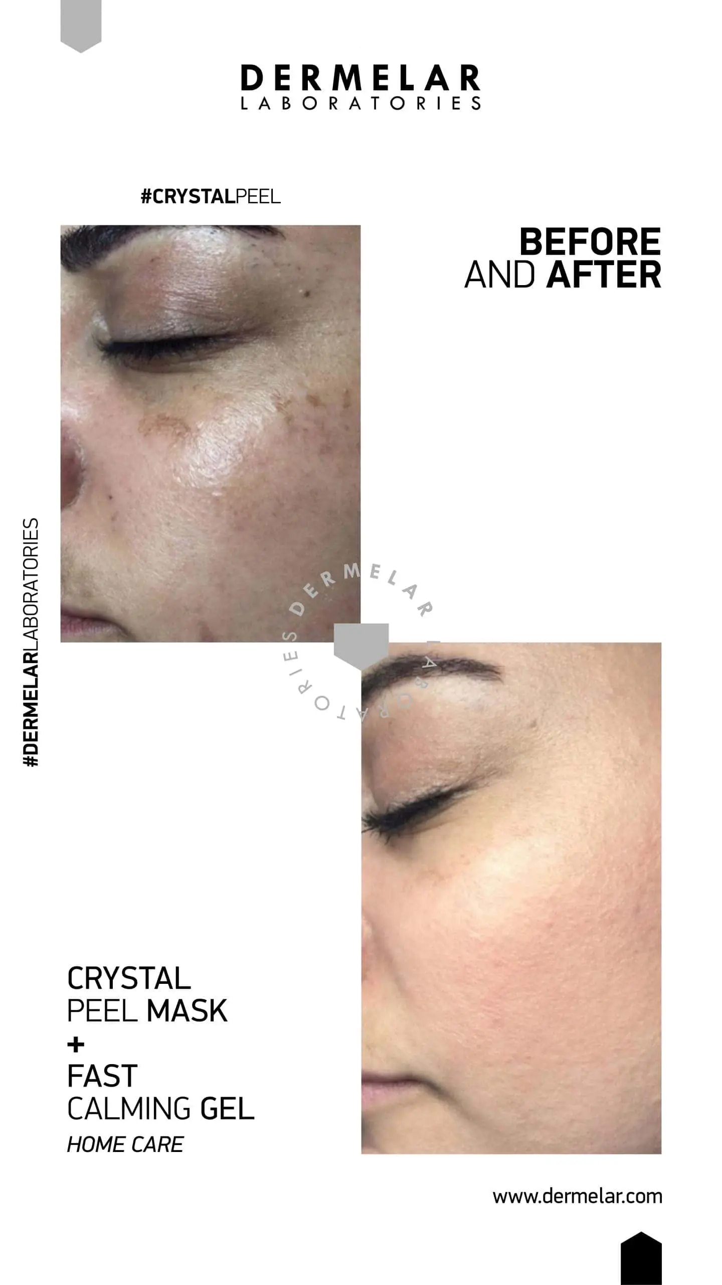 DERMELAR Profesionální set | Pleťové peelingy – detailní foto