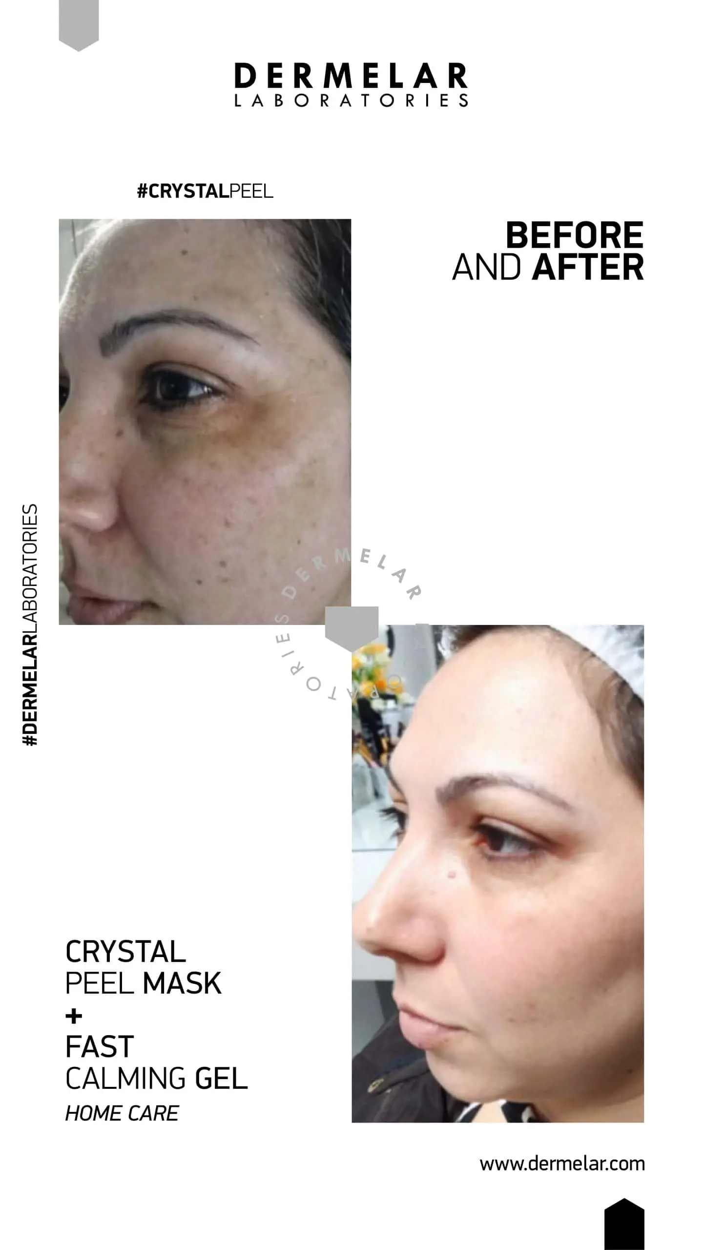 DERMELAR Profesionální set | Pleťové peelingy – detailní foto