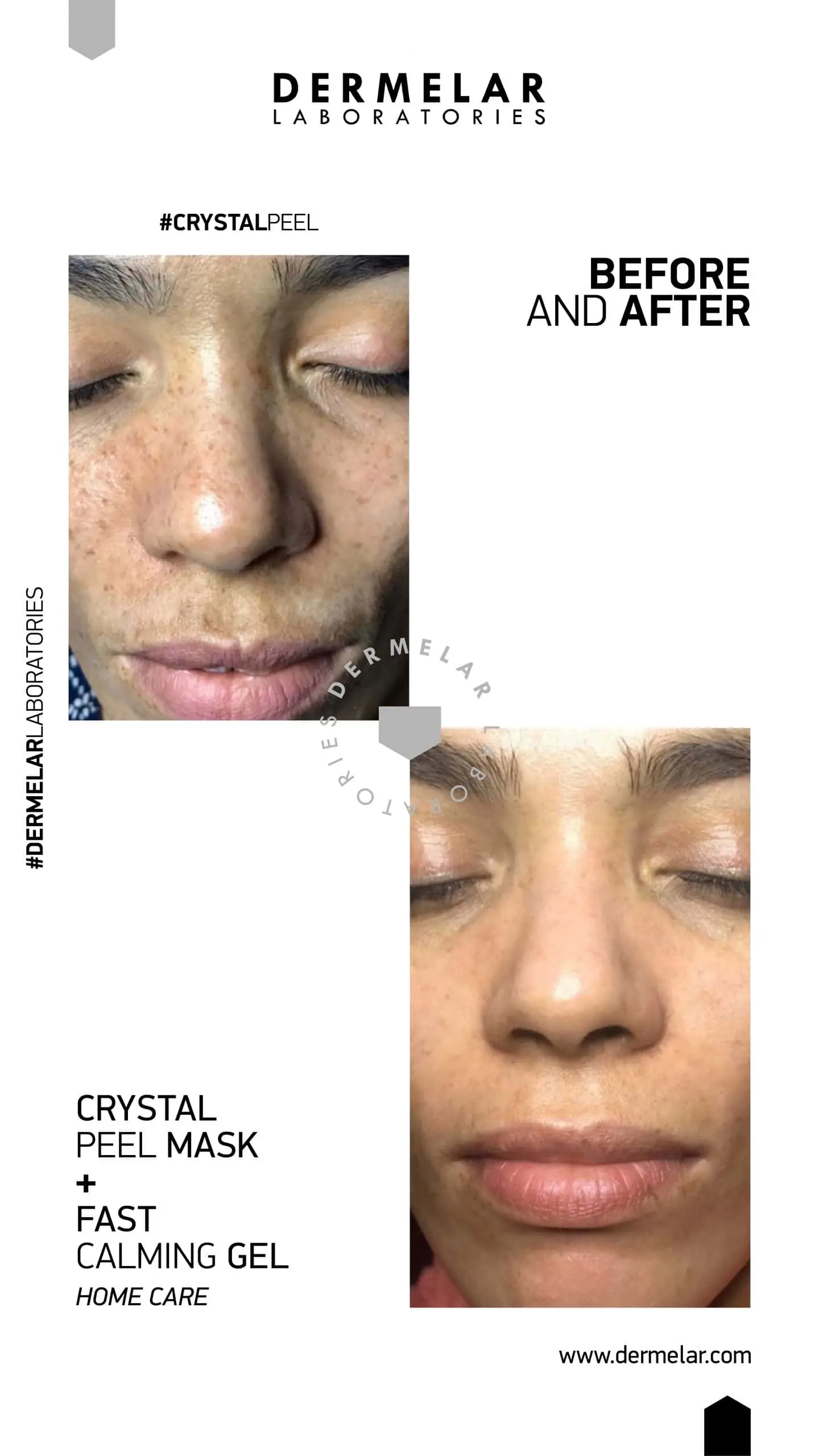 DERMELAR Profesionální set | Pleťové peelingy – detailní foto